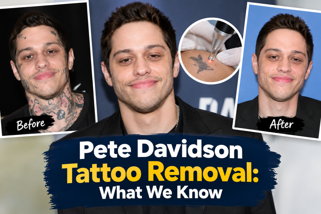 pete davidson tattoo removal